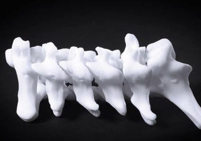 Modelowanie 3D skoliozy oferuje nieinwazyjne możliwości diagnostyczne